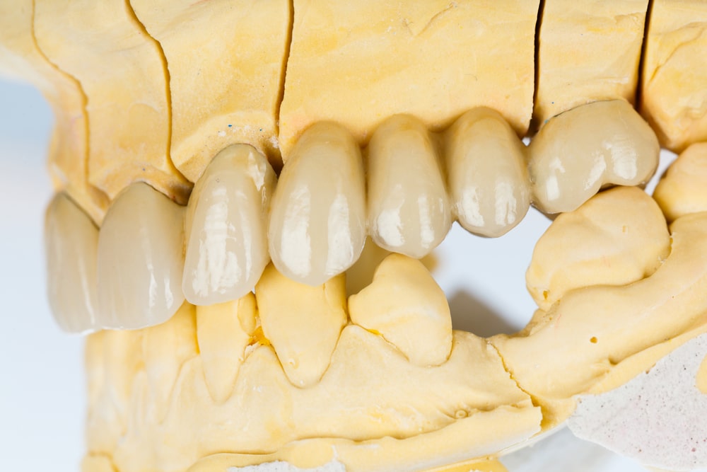 Dental Bridge Image of Replacement Teeth