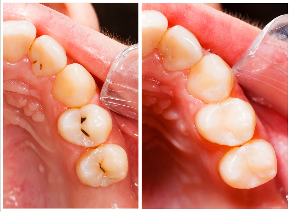 Images of Dental FIllings